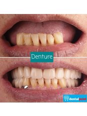 Dentures - Dentalpoint Kepong