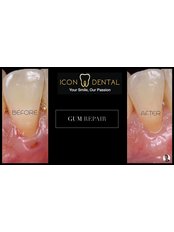 Gum treatment - Icon Dental Clinic