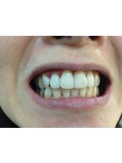 Zoom! Teeth Whitening - Klinik Pergigian Fauziah Menara Centara