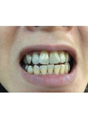 Zoom! Teeth Whitening - Klinik Pergigian Fauziah Publika