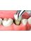 Lau Dental Clinic And Surgery Sri Petaling - Wisdom Tooth Extraction 