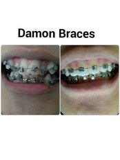 Damon™ Braces - Klinik Pergigian Ancasa