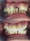Klinik Pergigian Bunny , Bunny Dental Clinic - Immediate painless single tooth replacement 