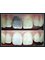 Klinik Pergigian Bunny , Bunny Dental Clinic - Single tooth whitening 