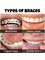 Klinik Pergigian Bunny , Bunny Dental Clinic - types of braces 