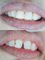Klinik Pergigian Bunny , Bunny Dental Clinic - Cosmetic filling for a beautiful smile 