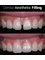 Klinik Pergigian Bunny , Bunny Dental Clinic - Aesthetic filling to close gaps for a confident smile! 