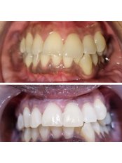 Teeth Whitening - Dear Dental Clinic @46