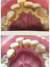 Teeth Cleaning - Klinik Pergigian Dentalia