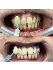 Teeth Whitening - Serene Smile Dental Clinic