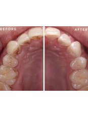Teeth Cleaning - Serene Smile Dental Clinic
