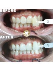 Teeth Whitening - Smile Craft Dental Clinic Puchong