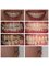 Smile Arts Dental Clinic - Braces treatment for teeth crowding and asymmetr arches 
