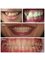 Smile Arts Dental Clinic - Braces treatment for crowded teeth 