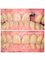 Smile Arts Dental Clinic - Dental Implant 