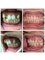Smile Arts Dental Clinic - Braces treatment for teeth crowding  