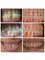 Smile Arts Dental Clinic - Braces treatment for lower jaw protrusion 
