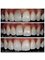 Smile Arts Dental Clinic - Internal tooth bleaching + Composite Bonding 