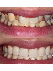 Braces - Smile Doctor Dental Clinic