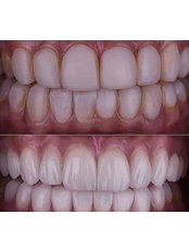 Porcelain Veneers - Smile Doctor Dental Clinic