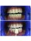 Dr Teeth Dental Clinic - Zoom Whitening System  