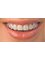 Dr Teeth Dental Clinic - Smilefast Ceramic Braces 
