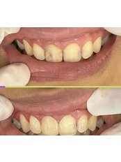 Fillings - Mysenyum Dental Clinic