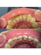 Scaling & Polishing - Mysenyum Dental Clinic