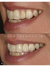Veneers - Pearl Dental Clinic
