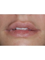Lip Augmentation - Prodent Care Dental&Centre for Dental Implantology