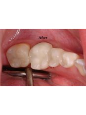 White Filling - Prodent Care Dental&Centre for Dental Implantology