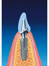 Dental Implants - Prodent Care Dental&Centre for Dental Implantology