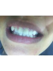 Dental Bonding - Bright Smile Dental