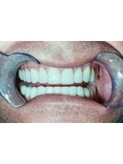 Dental Crowns - Dr. Carlos Vela