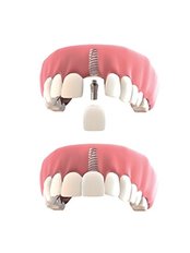 Dental Implants - Dr. Carlos Vela