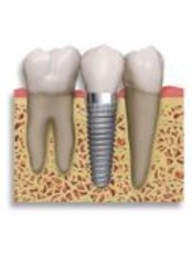 Dental Implants - Cabo San Lucas Dental Clinic