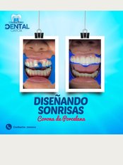 Consultorio dental García - Dental bridge