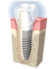 Implant Dentist Consultation - Dental Design Studio Cancun