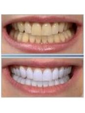 Chemical Teeth Whitening - Dental Office Cancún
