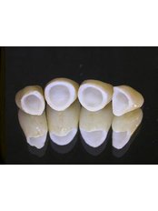 Zirconia Crown - Hospident Cancun Dental Service - All Specialties in one place