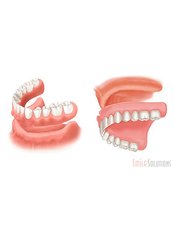 Dentures - Hospident Cancun Dental Service - All Specialties in one place
