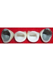 Zirconia Crown - Hospident Cancun Dental Service - All Specialties in one place