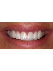 Porcelain Veneers - Hospident Cancun Dental Service - All Specialties in one place