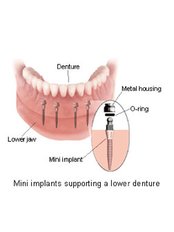 Mini Implants - Hospident Cancun Dental Service - All Specialties in one place