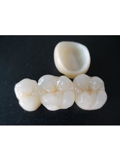 Porcelain Bridge - Hospident Cancun Dental Service - All Specialties in one place