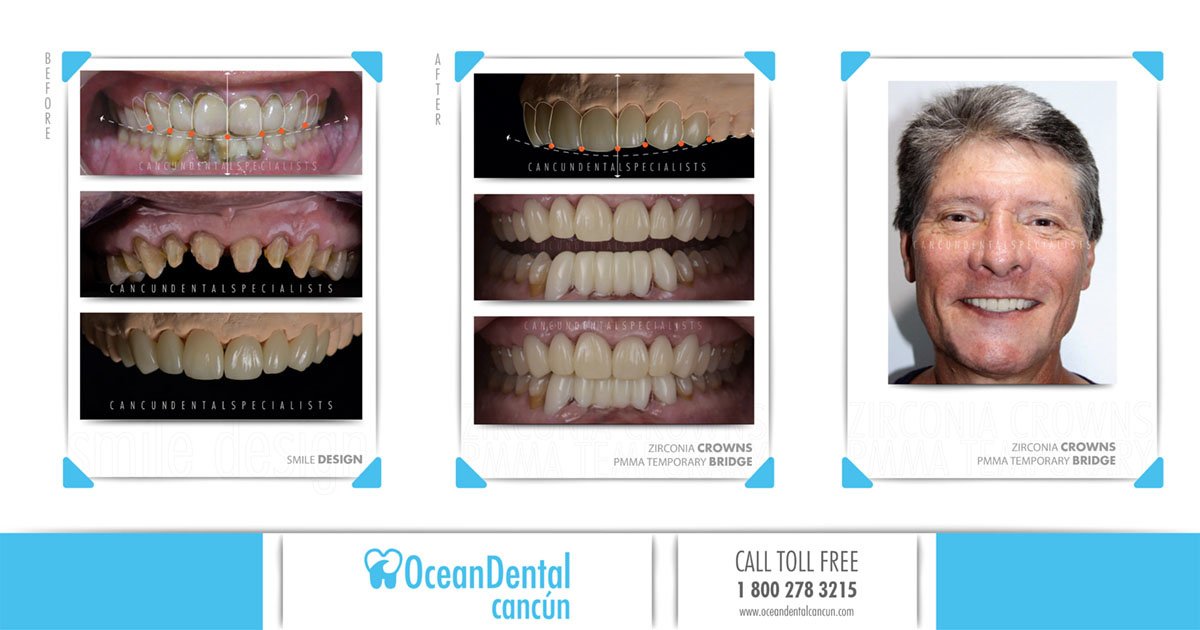 Ocean Dental Cancun, Mexico • Read 116 Reviews