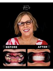 All-on-4 Dental Implants - SkyDental Cancun