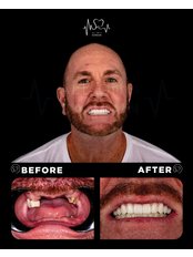All-on-4 Dental Implants - SkyDental Cancun