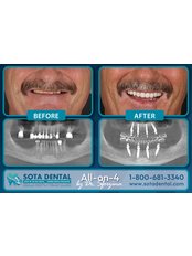 All-on-4 Same Day Teeth - SOTA DENTAL CANCUN