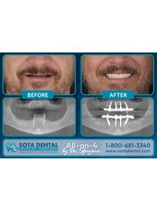 All-on-4 Same Day Teeth - SOTA DENTAL CANCUN